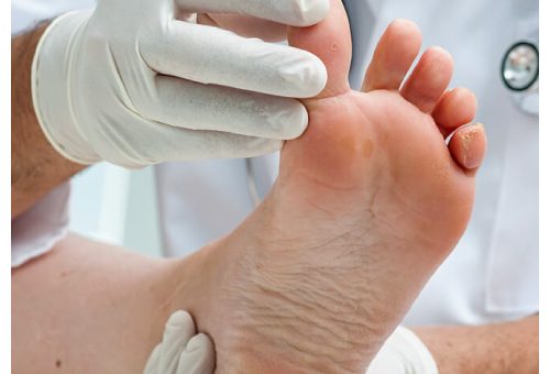 Care of the Diabetic Foot