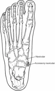 Accesory-Navicular-Bone
