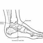 Accesory-Navicular-Bone1