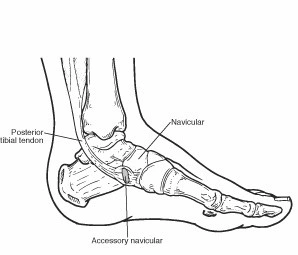 Accesory-Navicular-Bone1