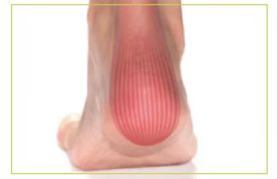 Achilles Tendonitis-التهاب وتر اكيلس