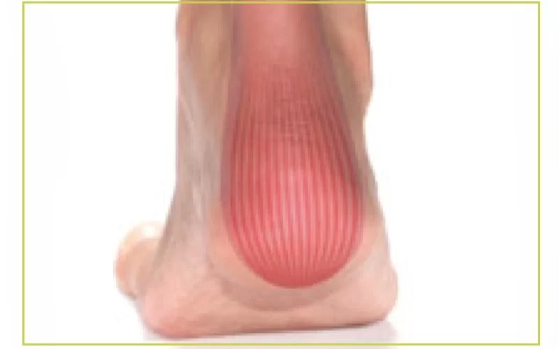 Achilles Tendonitis-التهاب وتر اكيلس