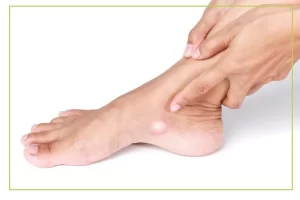 متلازمة-نافيكولار