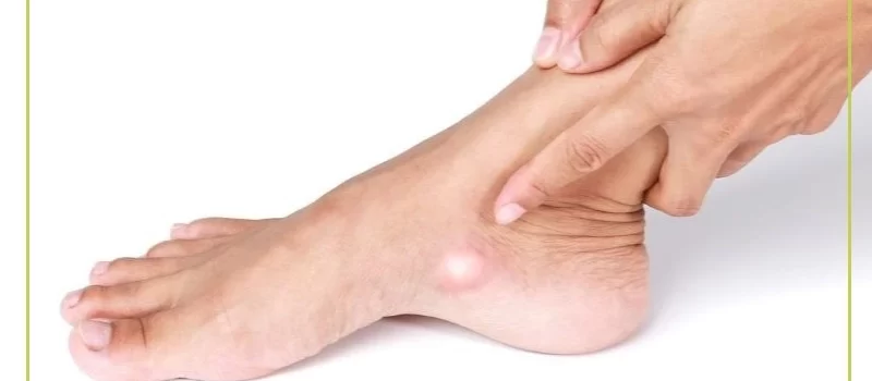 متلازمة-نافيكولار