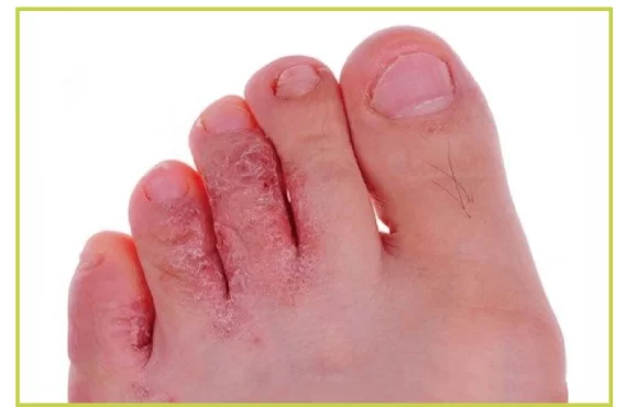 -Athlete’s footمرض-القدم-الرياضية