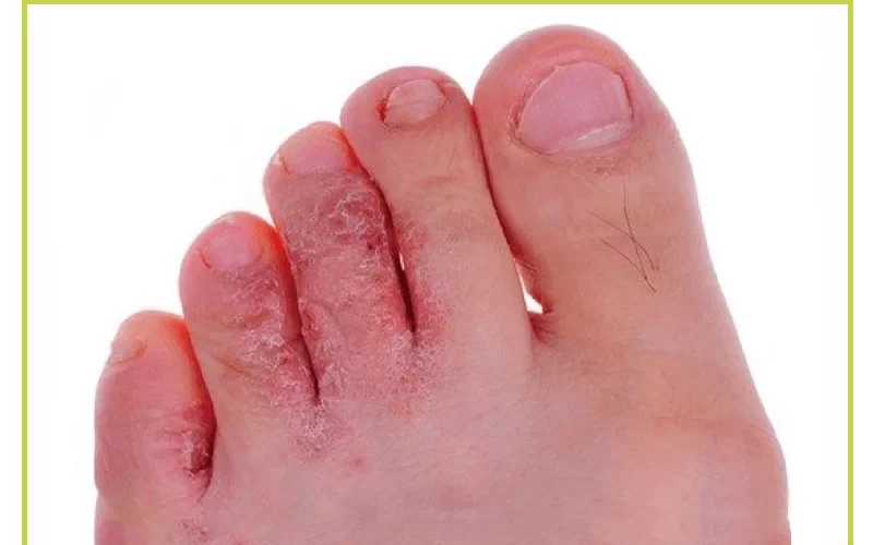 -Athlete’s footمرض-القدم-الرياضية