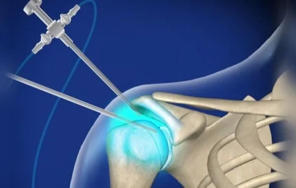 after-shoulder-surgery-مابعد-جراحة-الكتف